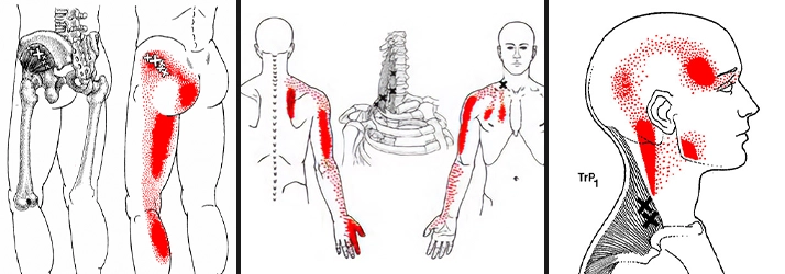 Chiropractic Glendale CA Trigger Points